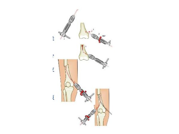 上海開為Carefix彈性髓內(nèi)針
