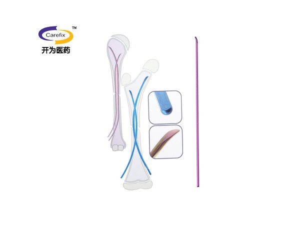 上海開(kāi)為Carefix第二代彈性髓內(nèi)針