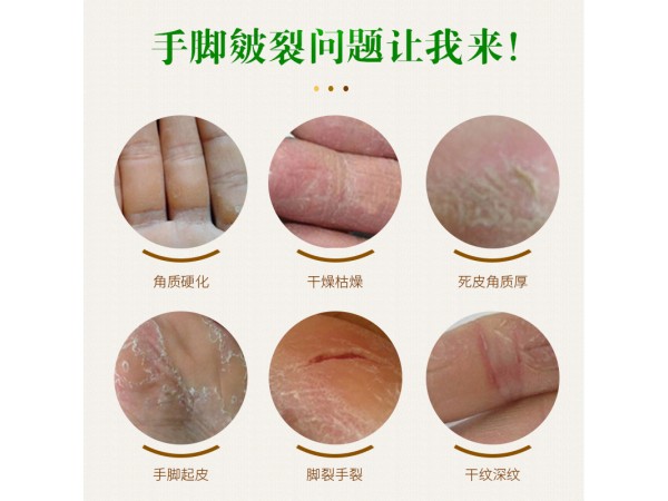 溢美愈合膏