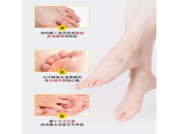 腳氣膏代加工 爛腳丫止癢抑菌去腳臭腳氣 腳部護理產品廠家貼牌定制